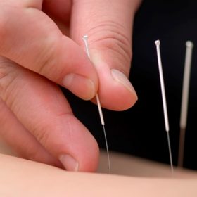 Bergen akupunktur og massasje
